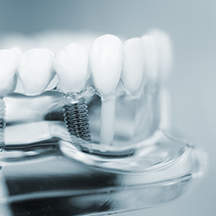 インプラント・骨移植治療